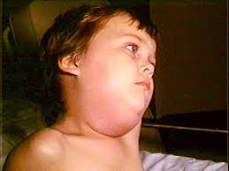 Mumps virus outbreak